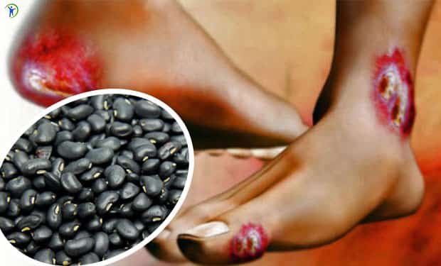 Remedio casero con frijol negro para curar el pie Remedio casero con frijol negro para curar el pie