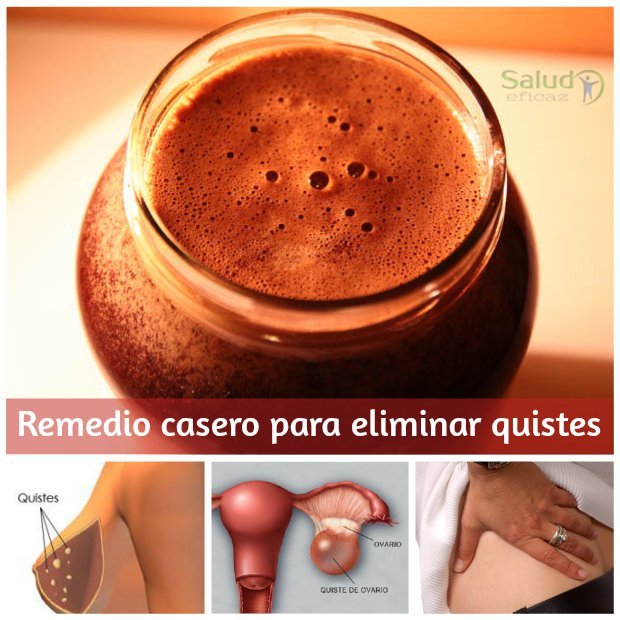 remedio casero para quistes en los ovario senos y riñones